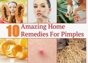 Home Remedies for Oily Skin and Pimples